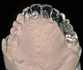 歯型の模型（ステント）